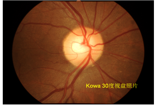 此图为视盘30度照片,适于青光眼筛查和诊断,可清晰观察视盘形态和视