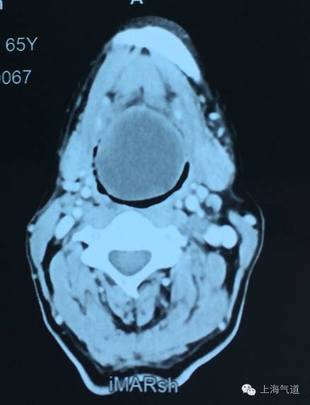 图1 舌根巨大肿物,整个喉腔被阻塞,会厌,声门无法暴露患者,男性,65岁