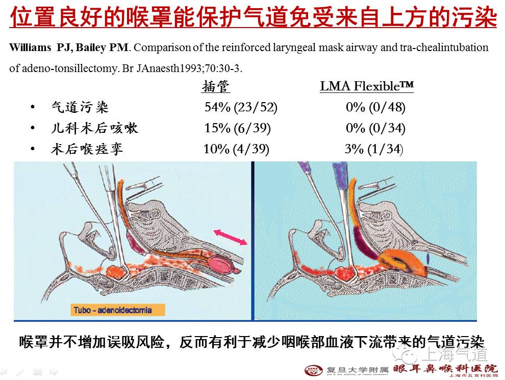 如何做好喉罩麻醉走出定式思维的常见误区